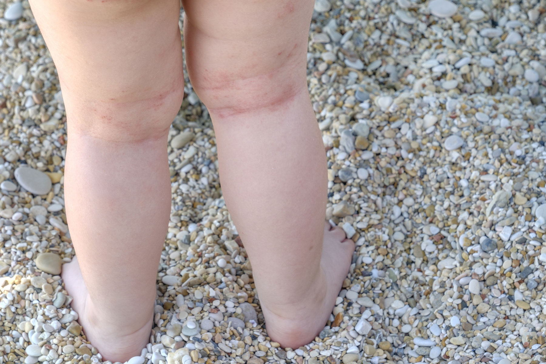 Et lite barn, som har utslett bak knærne, står med bena i sanden. Illustrasjonsfoto: Mostphotos